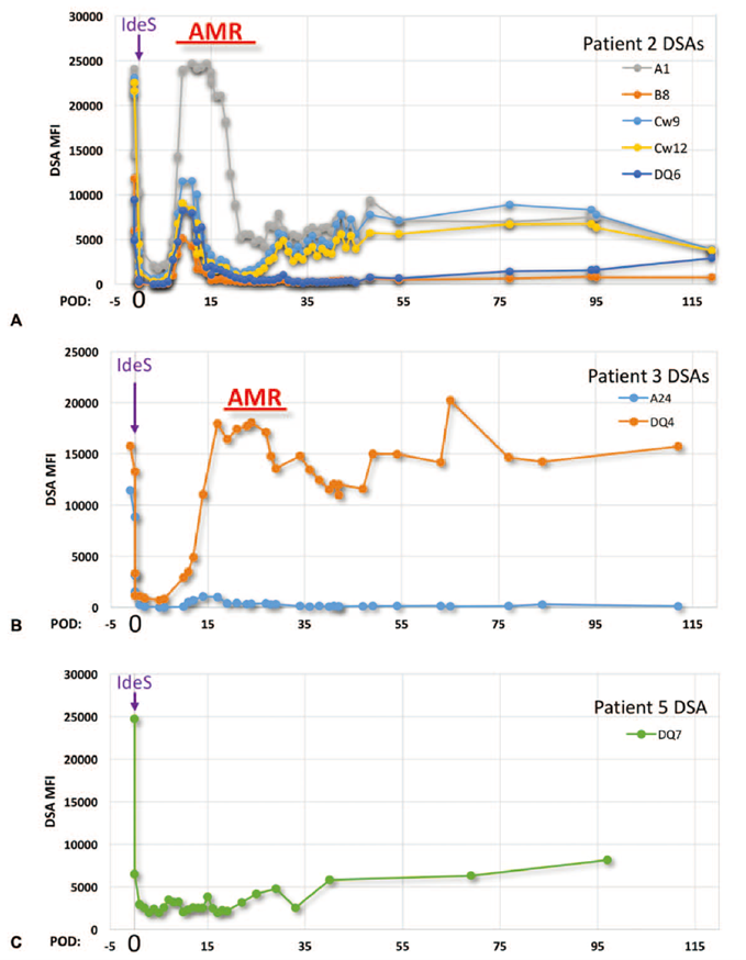Temporal trends of donor-specific antibody levels in anti-GBM disease patients treated with IdeS
